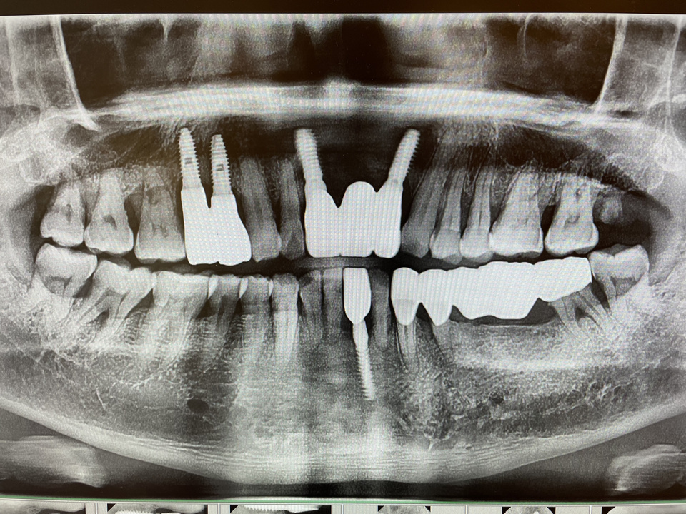 그림 10.  최종 보철 이후 점검 방사선 사진