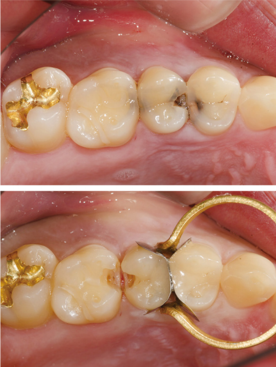 촬영 장비/Ceramist  Kodak DCS 14 pro N  Nikon Medical Nikkor 120 ring flash  1:1.2 배율