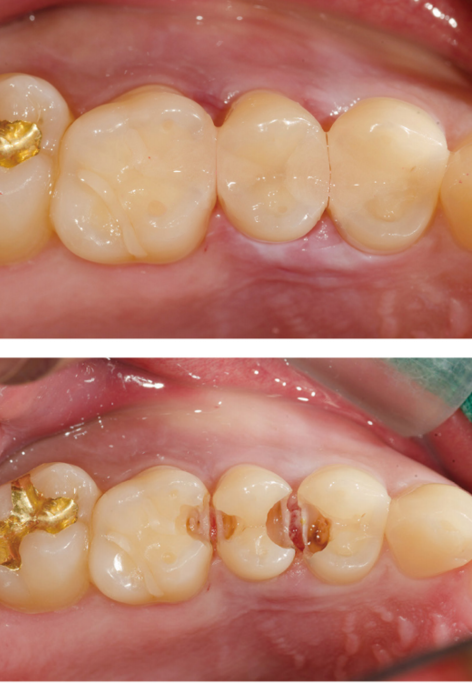  촬영 장비/Ceramist  Kodak DCS 14 pro N  Nikon Medical Nikkor 120 ring flash  1:1.2 배율