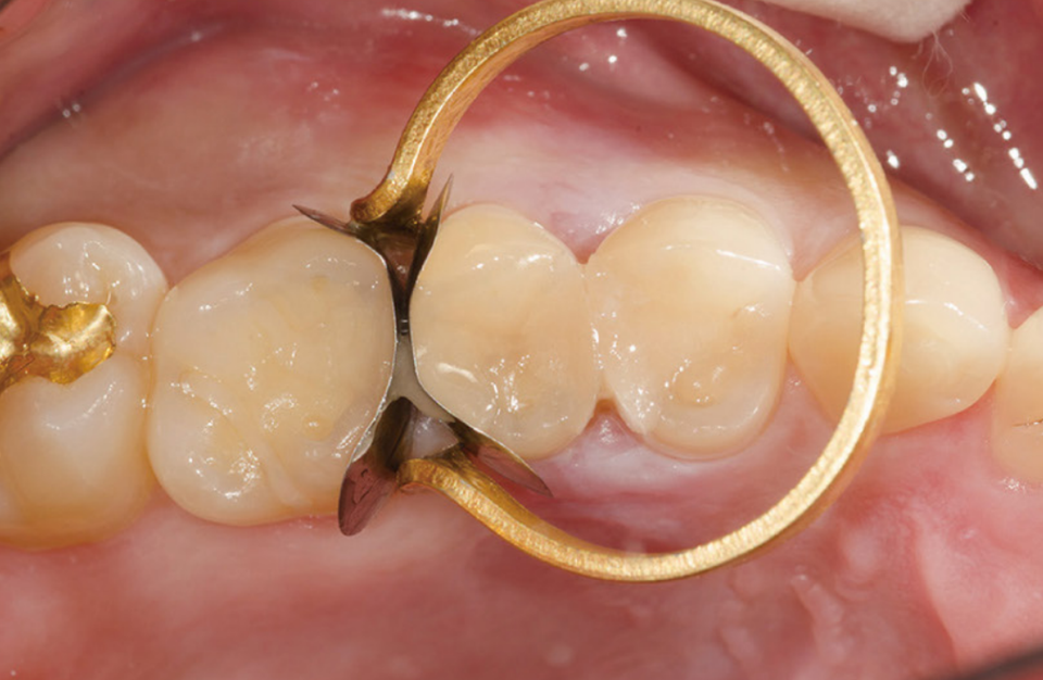 촬영 장비/Ceramist  Kodak DCS 14 pro N  Nikon Medical Nikkor 120 ring flash  1:1.2 배율