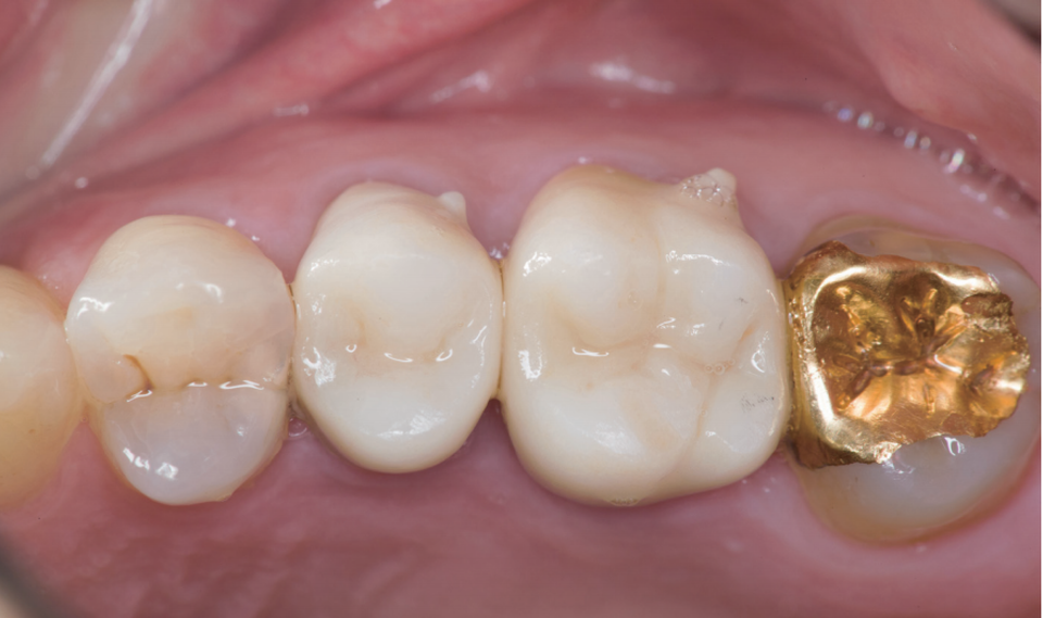 #25, #26 근관치료와 zirconia 재보철  촬영 장비/Ceramist  Kodak DCS 14 pro N  Nikon Medical Nikkor 120 ring flash  1:1.2 배율  이안비기공소 박남현 소장