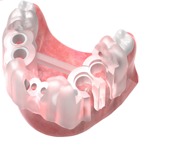 Sleeve Type, GPS PIN Type, Open Type 복합