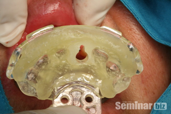 바로 가이드 식립 이미지