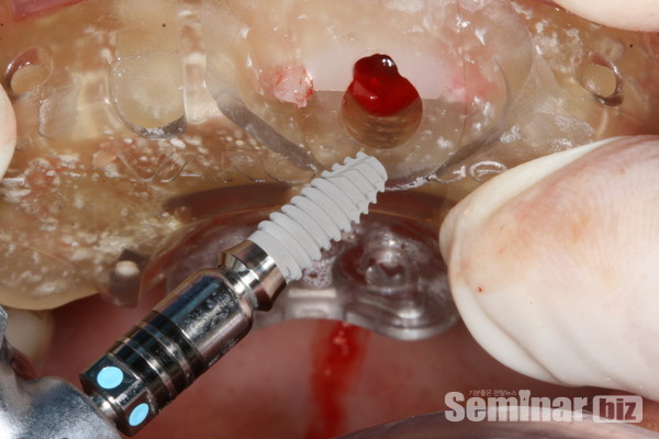 바로가이드 식립 이미지