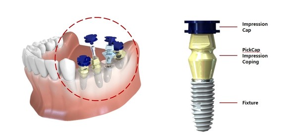 (주)네오바이오텍, 신개념 임플란트 인상채득 툴 ‘PickCap Impression Coping’
