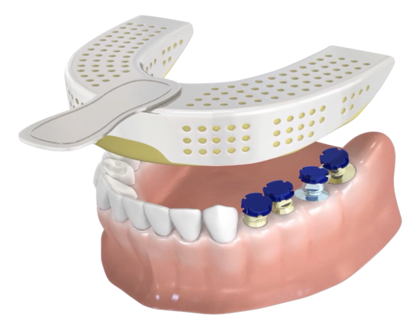 (주)네오바이오텍, 신개념 임플란트 인상채득 툴 ‘PickCap Impression Coping’