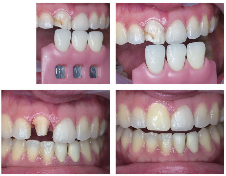 촬영장비/Ceramist/아이폰6/ Medi plus lightringflash / 와이비기공소임영빈소장