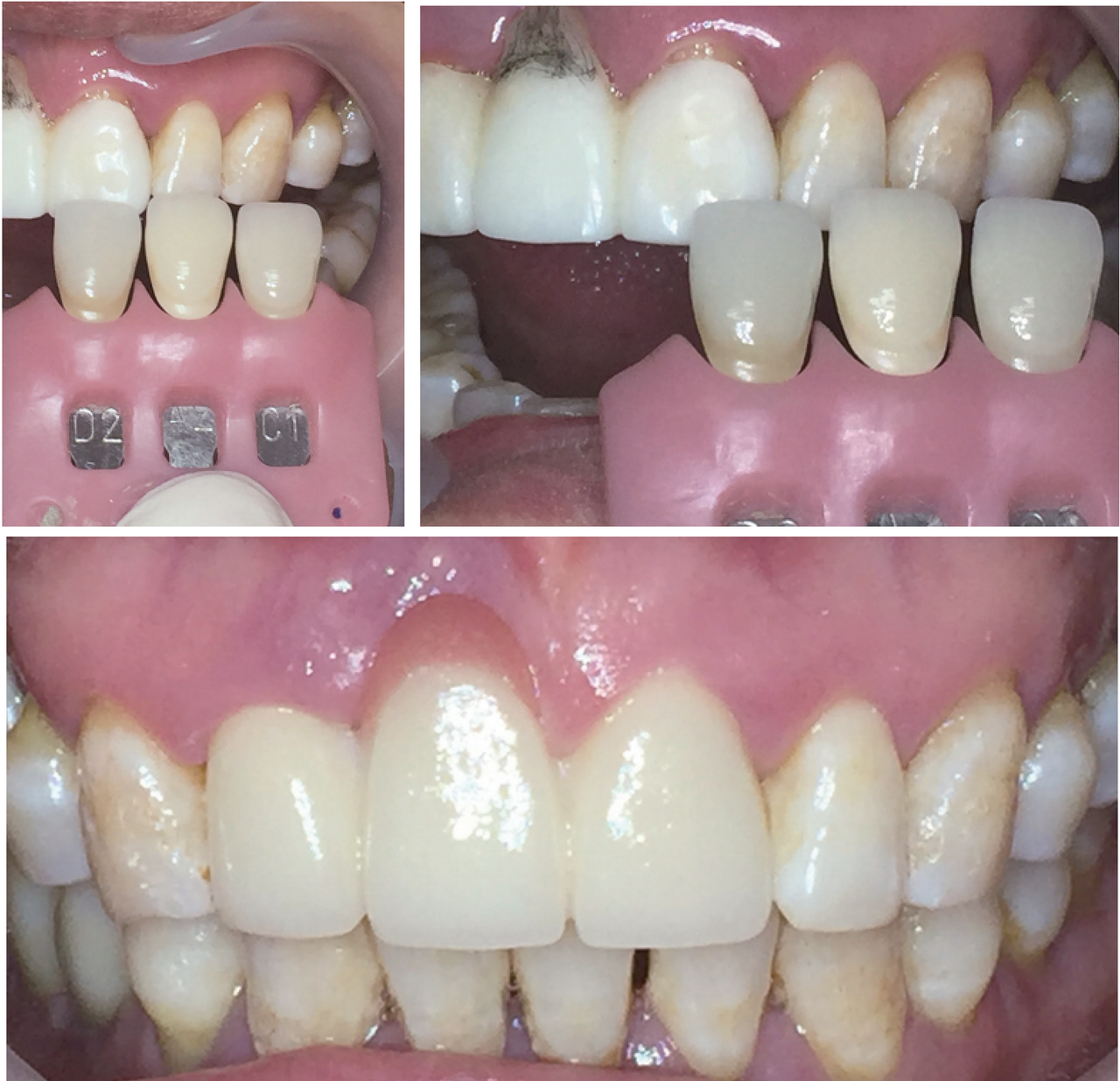촬영 장비/Ceramist 아이폰 6이안비기공소 박남현 소장