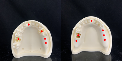 덴티폼 Hands-on 식립 위치