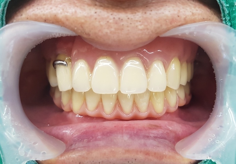구강내 하악 All on 4 착용 