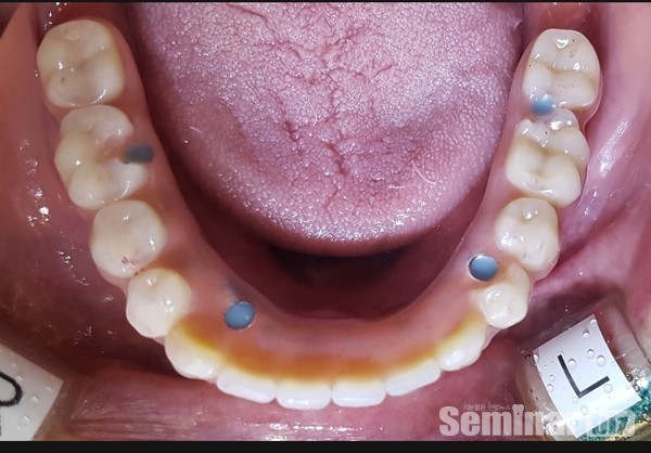 구강내 하악 All on 4 착용 