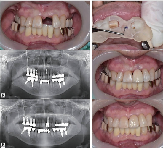 그림 14. 임플란트에 의한 단일 치아 implant supported single crown에 의한 수복증례