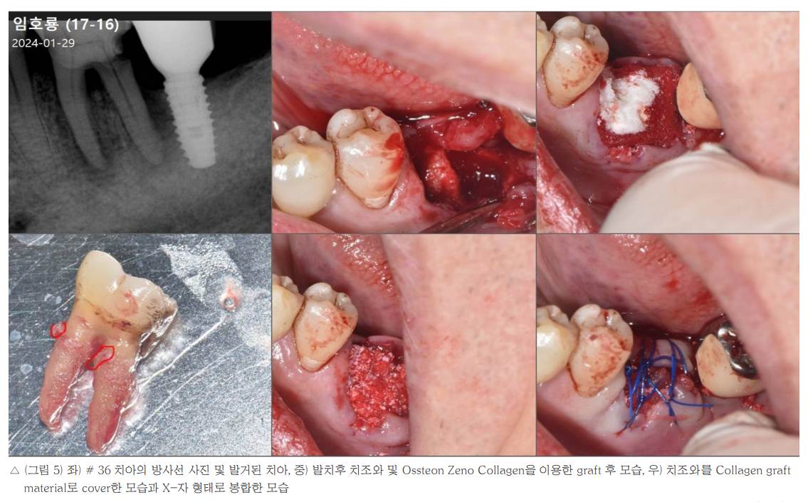 △ (그림 5) 좌) # 36 치아의 방사선 사진 및 발거된 치아, 중) 발치후 치조와 및 Ossteon Zeno Collagen을 이용한 graft 후 모습, 우) 치조와를 Collagen graft material로 cover한 모습과 X-자 형태로 봉합한 모습