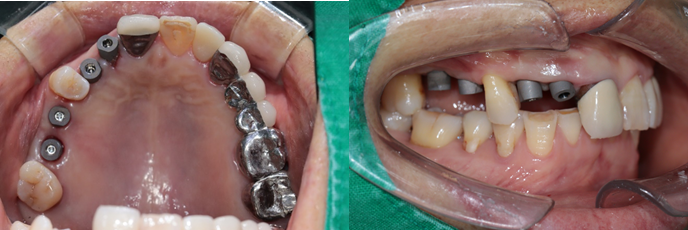 힐링캡 , 힐링캡 제거후 세팅전