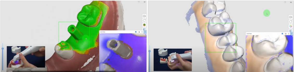 △ (그림 11-2a) Step 1. Scan body scanning                    △ (그림 11-2b) Step 2. Opposing tooth scanning