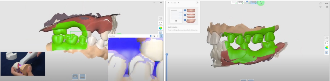 △ (그림 11-2c) Step 3. Bite scanning without Scan body  △ (그림 11-2d) Step 4. Check final state