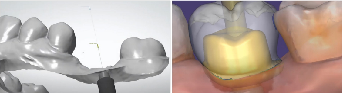 △ (그림 11-2e) Step 5. Virtual implant fixture analog positioning and Design of Custom abutment and Crown