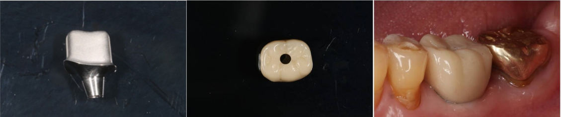 △ (그림 11-2f) Step 6. Milled Custom Abutment (TI Blank, Dentium) & Zirconia Crown (bright Mono, Genos)