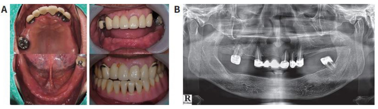 △ (그림12)（A）초진시 상하악 구강내 사진    (B) 파노라마 방사선 사진