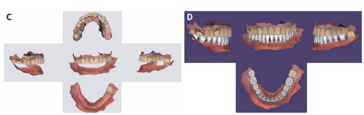 △ (그림12)（C) Intraoral scanner에 의해 구강내 scan data   (D) Exo CAD에 의한 Vertual wax-up