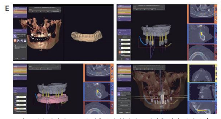 △ (그림12) (E) 합성한 data를 이용하여 임플란트 식립을 위한 가상 수술 및 SurgiGuide으I 3-D printing 제작을 위한 작업 과정
