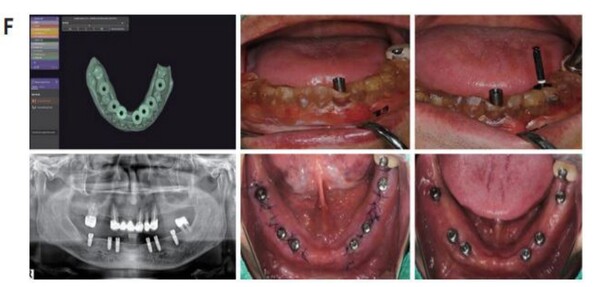 (F)SurgiGuide를 이용한 임플란트 일차수술 후 상태