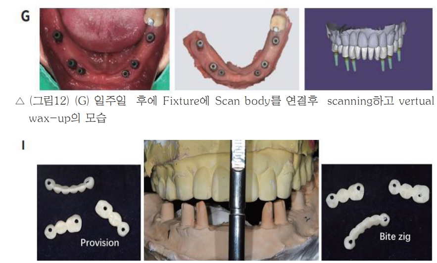 △ (그림12) (I) 정밀한 최종 보철물 제작을 위한 Bite jig와 final impression에 의한 모형을 교합하기에 mounting한 모습.