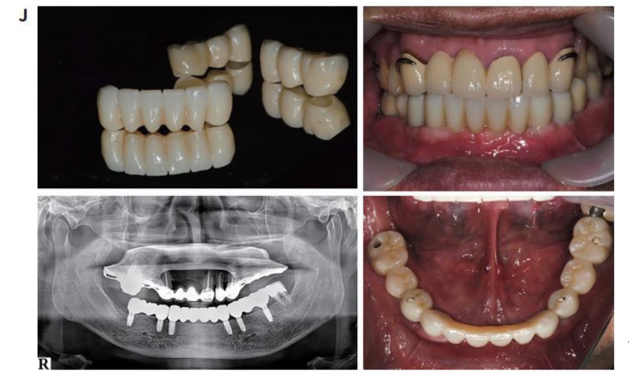 △ (그림12) (J) 상악 RPD, 하악에 3개의 final Ziconia bRIDGE에 의해 보 철수복이 완성된 모습.