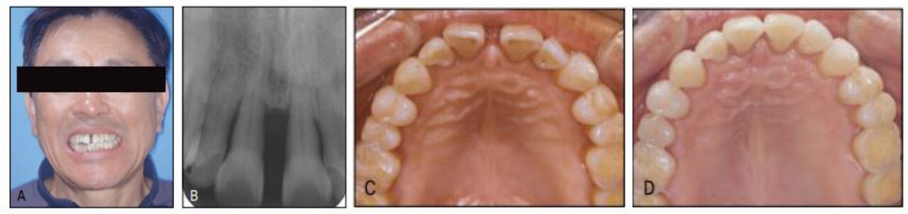 △ (그림 23-1.) 병적 치아이동으로 인해 상악 전치부 공간이 나타난 고령 환자 예. 치주질환으로 인해 전치부 공간이 크게 나타나 이의 심미적 회복을 위해서는 발치 후 보철이 필요할 것이라는 이야기를 듣고 치료를 주저하였으나 딸네 집에 머무르다 그 지역 개원의로부터 교정을 권유받음. 그리고 투명 교정 장치를 이용하여 간단하게 교정치료를 받음. 자연치를 보존하면서 전치부 심미를 회복하는 치과치료로 고령화 교정의 필요성이 최근 크게 부각되고 있다.