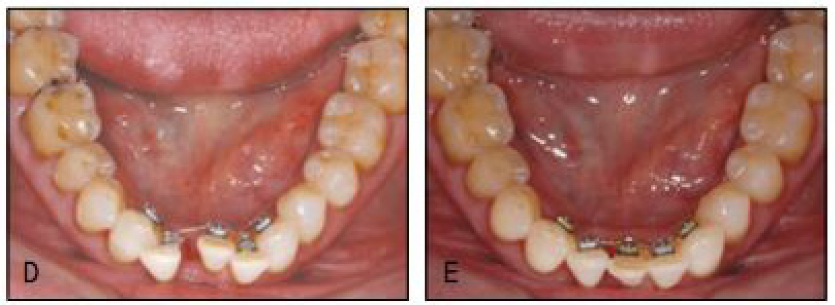 △ 그림 23-2. 치주질환으로 인해 하전치 일치 발거 판정을 받은 고령 환자 예. 장기간 치주치료 관리를 받았으나 결국 발치 판정을 받고 크게 실망하 였던 73세 환자로 담당 치주의에 의해 교정치료를 권유받고 3전치 배열로 교정치료를 받게 됨. 보철치료를 받지 않 게 되었다는 것도 좋아했으나 교정적 배열로 남은 인접치의 치주 건강을 도모할 수 있게 된 것에 환자는 크게 만족하였다.
