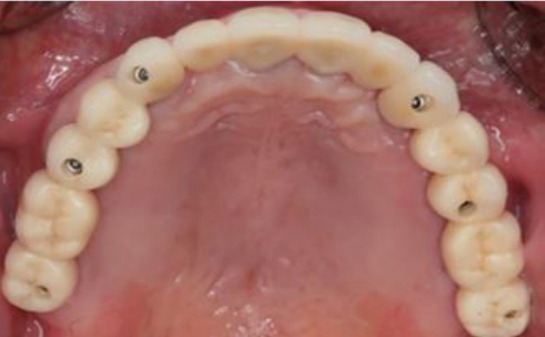 △ (그림13)3개의 지르코니아 Bridge에 의해 수복