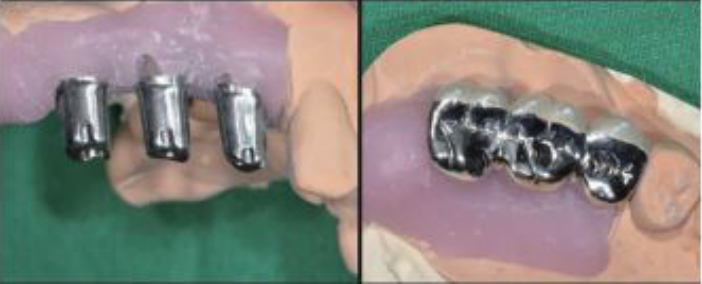 △ (그림14) 맞춤형 지대치와 PFM crown의 교합면