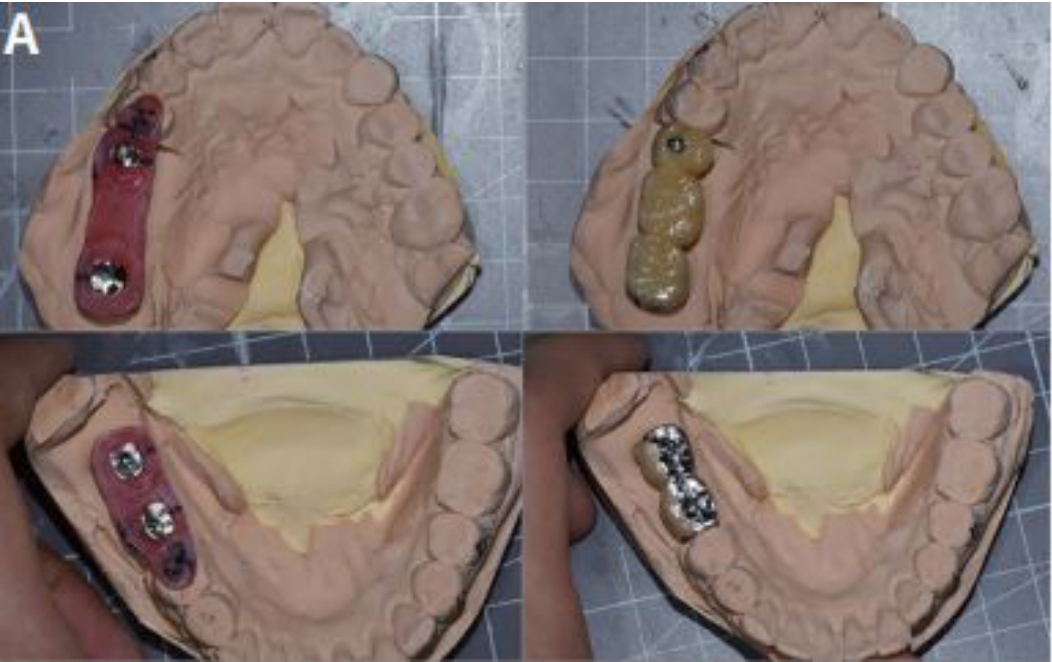 △ (그림15)（A）완성된 임플란트 보철물