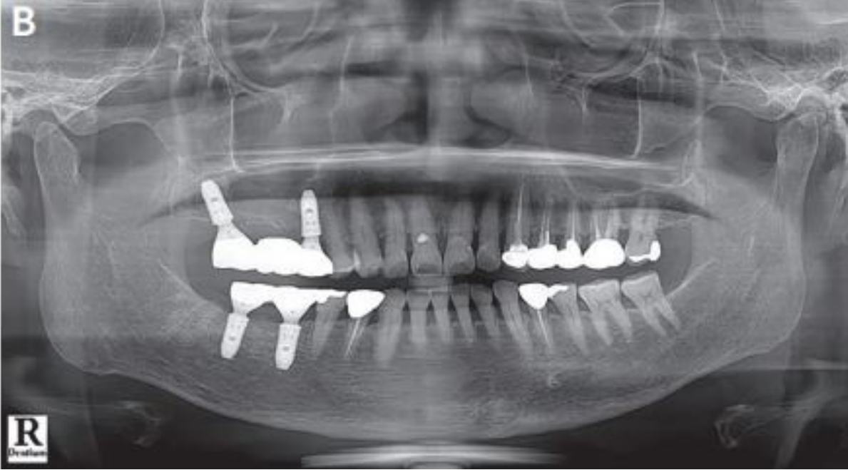 （B）방사선 사진에서 잘 끼워진 abutment와 적합도가 좋은 crown을 보여준다.