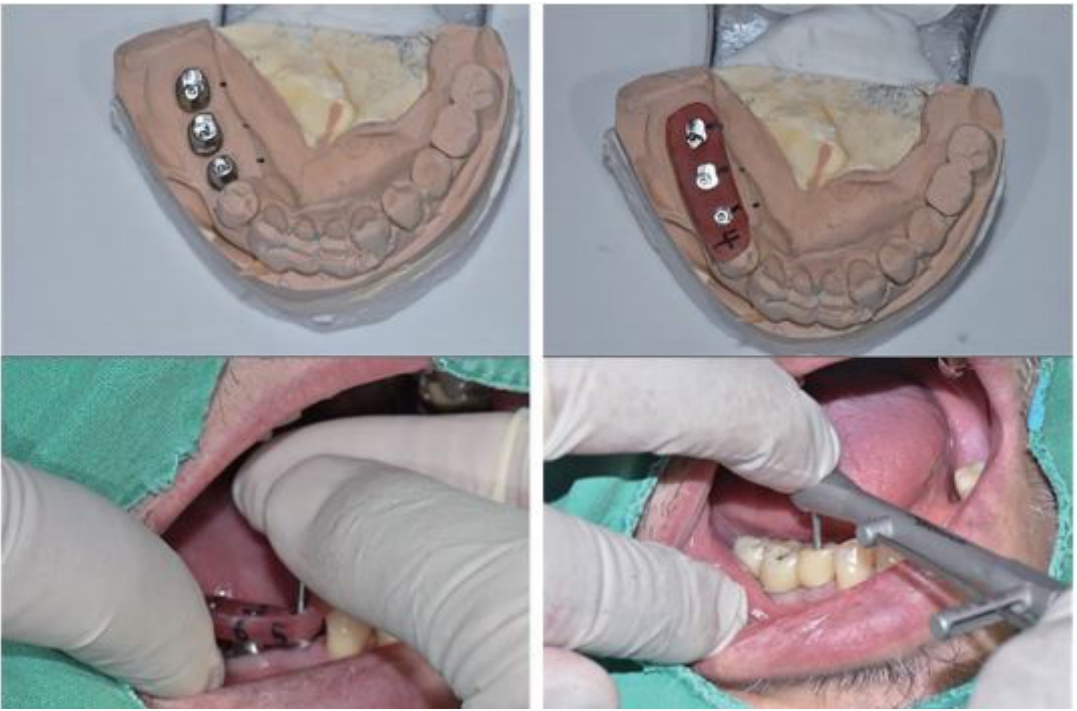 △ (그림16)Custom abutment를 fixture에 연결하고 보철물을 끼운 상태에서 screw tightening 하는 것이 좋다.