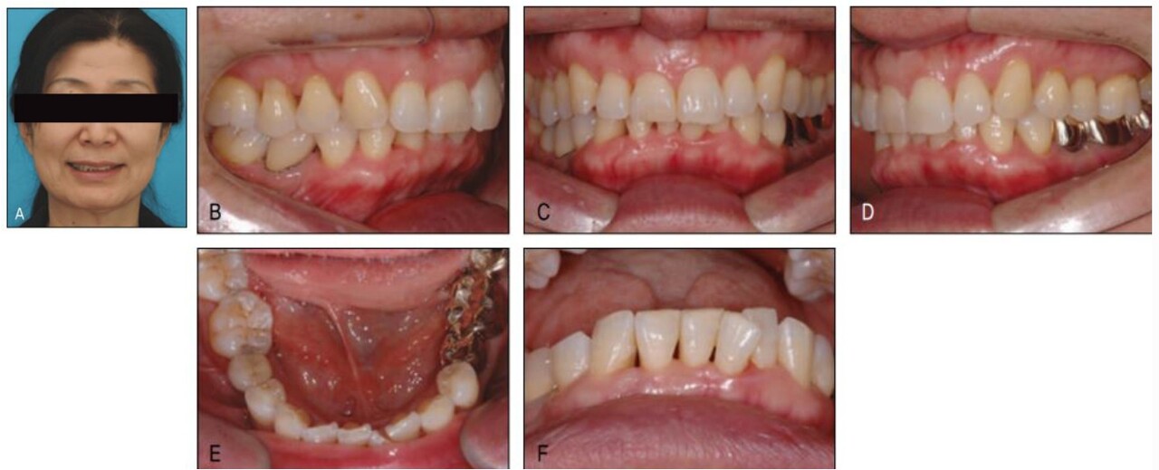 △ 그림 23-3. 지난 수년간 하전치부의 크라우딩이 증가하여 이를 교정하고자 자발적으로 내원한 고령 환자 예. 특별한 치주 문제나 증상은 없었으나 본인의 치열이 이전보다 더 틀어지면서 소위 안티에이징 목적으로 교정을 하게 되었다.