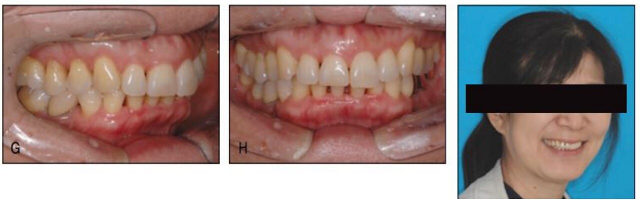△ 그림 23-4. 인접면 스트리핑과 투명교정장치로 간단하게 하전치부만 부분적으로 얼라인하는 교정치료를 받았다. 교정 후 초진 시와는 달리 자신 있게 웃는 모습에서 셀프이미지 증진 목적의 고령자 교정 수요 증가 추세를 엿볼 수 있다
