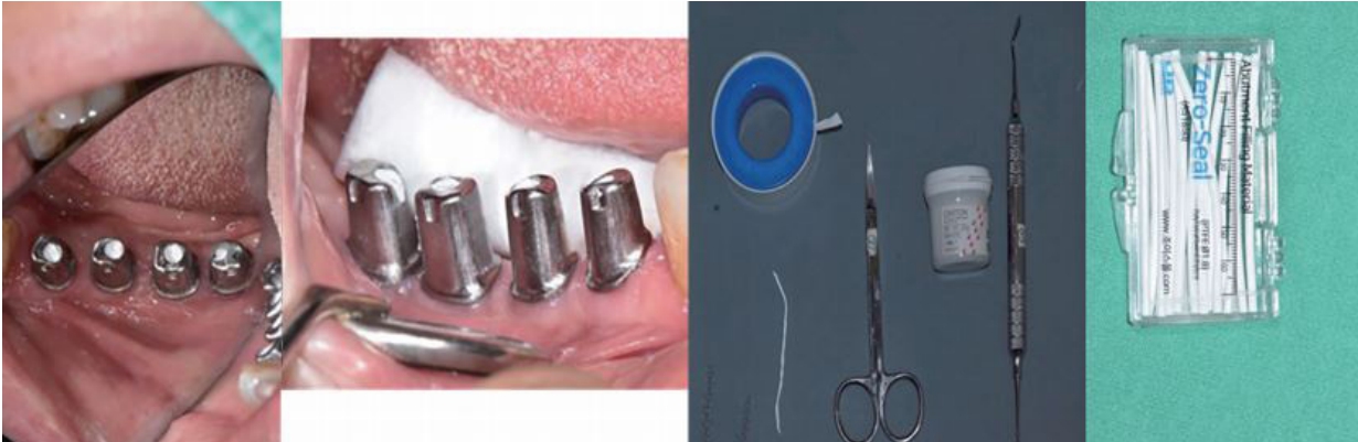 (그림17)Screw hole은 Teflon strip으로 채운 후 hole을 Caviton으로 막아주는 것이 좋다. Zero Seal 같은 상품화되어 있는 것을 사용하는 것도 추천된다.