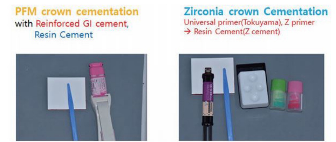 (그림18) 좌) PFM보철물을 위한 RMGI cement, 우) Ziconia 보철물을 위한 Resin cement와 Universal primer