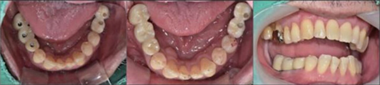 (그림19) 임플란트 abutment가 tightening되고 보철물의 cementation 후에 flowable resin으로 screw hole을 채운 후의 모습.