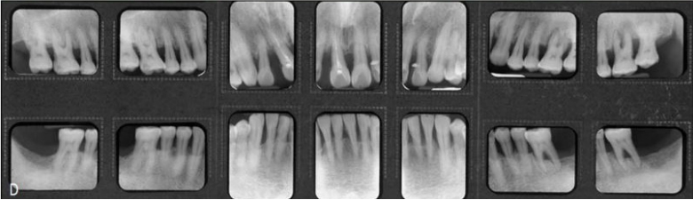 △ (그림 23-5) 치주질환으로 심한 PTM이 나타나 기능적, 심미적 회복을 위해 교정을 한 65세 고령 환자 증례. 전치 및 구치부 전악에 걸쳐 심한 치주 염증으로 인해 치주수술을 받은 후 모습으로, 염증은 다 제거되었으나 이전의 치주질환으로 인해 상악 전치부 치간 공간 외, 특이하게도 구치부에서도 소구치의 협측정출 등 치아이동이 나타나 매우 불안정한 교합이 초래되었다. 불안정한 dual bite 상태에서 구치부 보철치료를 할 수 없기에 PTM 이전의 상태로 치아 위치를 재위치 시키는 교정치료가 필요하였다.