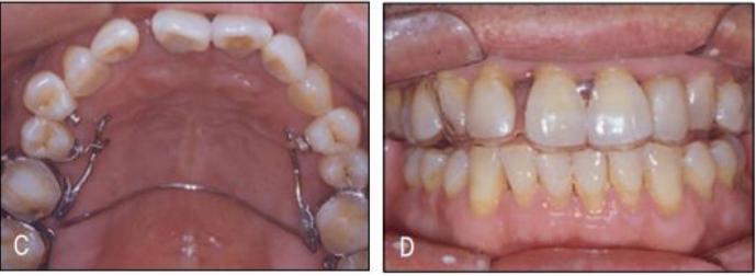 (그림 23-6) 전체적으로 치주 골지지가 불량한 상태이므로 소구치부 이동을 위해 좌우 제1, 제2대구치를 TPA 및 협측 와이어 납착으로 서로 스플린팅하여 고정원을 보강하였다(A, B). 약한 힘을 이용 하여 소구치를 하나씩 설측으로 재위치 시킨 후(C), 투명교정장치를 이용하여(D), 구치부 유지 및 전치부 교정을 시행하였다.(E, F)
