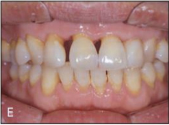 그림 E는 2개의 장치 사용 후 모습이고,