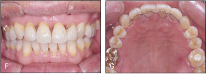 림 F와 G는 4개의 장치 사용 후 치료 종료 상태이다(E-G)