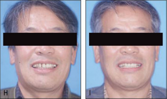 치주질환으로 인한 PTM과 함께 저하된 self-esteem이 교정치료로 크게 회복된 것을 볼 수 있다(H, I).