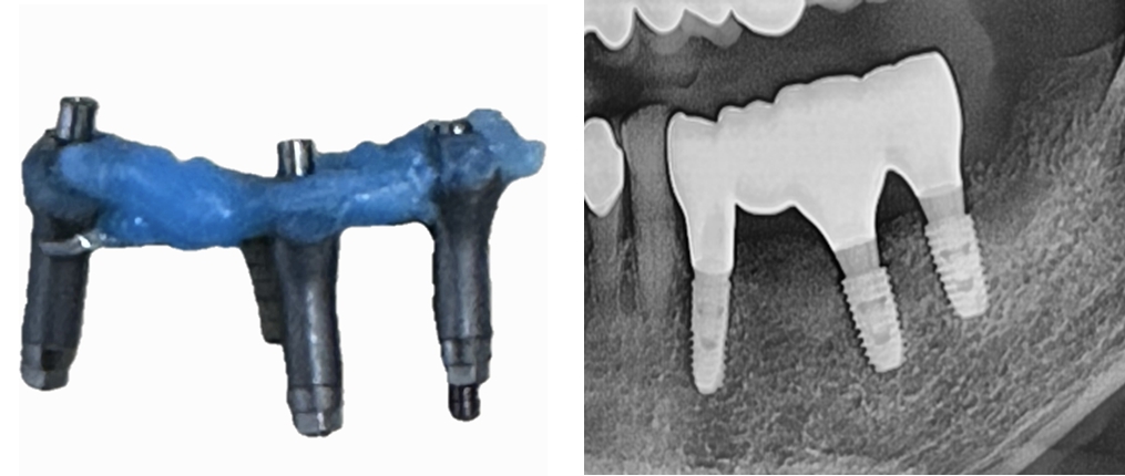 long span에서 정밀도를 높이는 디지로그   