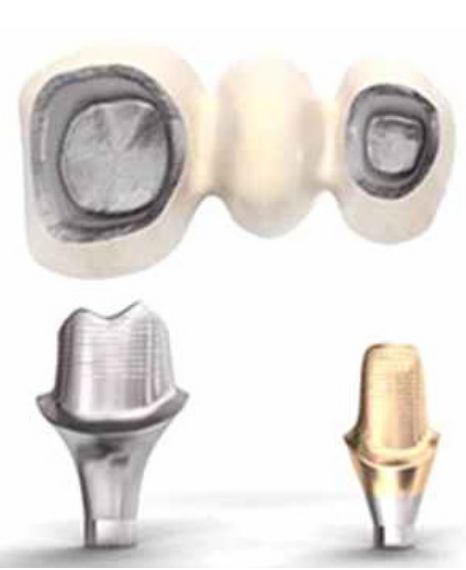 (그림2) Custom abutment의 Fixture에서부터 보철물 Margin까지의 형태는 Concave하거나 Straight 형태로 제작해주어야 한다.