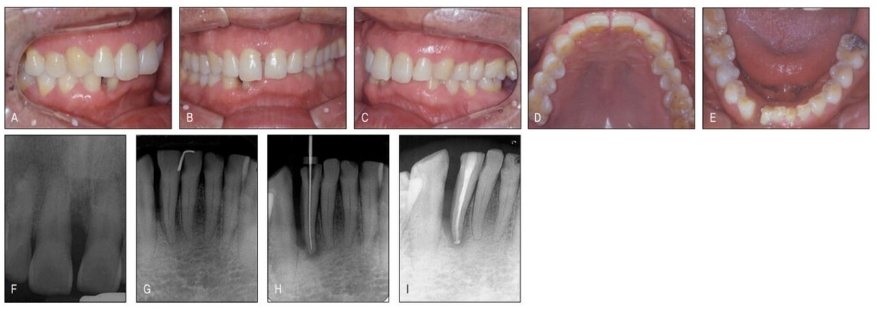 (그림 23-7) PTM으로 인해 공간 재분배 교정이 필요하나 비심미적 교정 장치로 인해 교정치료를 꺼리는 고령남자 환자 증례. 상악은 10년 전부터 서서히 공간이 생겼다고 진술한 반면, 하악은 급작스러이 우측 측절치 원심에 심한 공간이 일년 전에 발생하였다고 하였다. 지난 치과 병력을 보니 근관-치주 복합병소에 의한 농양으로 PTM이 심하게 나타난 것이었다. 이로 인해 정상적인 보철치료가 불가하여 공간 재분배를 위해 의뢰되었다