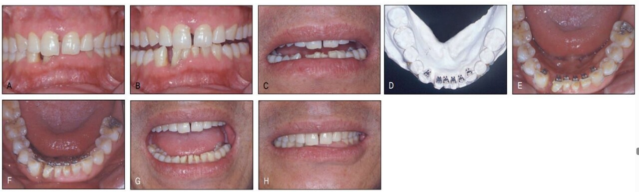 △ (그림 23-8) 하악 교정 외에도 비심미적인 정중 공간 클로져를 위한 상악교정도 필요하나 환자는 보철을 위해 꼭 필요한 하악에서의 교정만 하는 것으로 하고 상악 치료는 거부하였다(A~C). 과개교합으로 인해 순측부착이 불가하여 설측으로 장치를 부착하고 한 개의 와이어를 사용하여 간단히 치료하였다(D~F). 하악교정 후 환자에게 다시 상악 교정을 권유하였더니 환자는 흔쾌하게 상악도 교정을 하겠다고 하였다. 하악에서처럼 심미적 교정장치로 치료 받을 수 있을 것으로 기대했기 때문이었다(G, H)