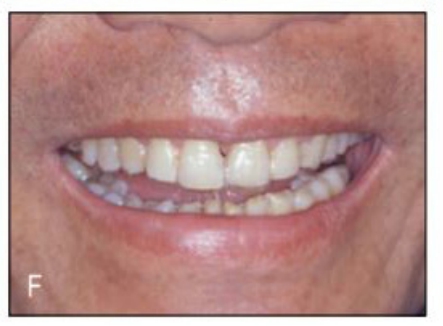 (그림 23-9) 상악에서는 투명교정장치를 이용하여 치료하였다. 설측교정은 과개교합으로 인해 불가하기도 하지만 PTM이 나타난 환자의 특성상 투명교정장치가 환자 뿐 아니라 술자에게도 훨씬 편리한 장 치가 될 수 있는 증례이기 때문이었다. 상악에 장치를 낀 모습인데 매우 심미적인 것을 볼 수 있으며 교정치료를“민망해 하는”고령 환자들에게 큰 도움이 될 것으로 기대할 수 있다.